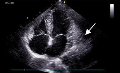 Case Report: Long-Term Outcome Following Maximal Partial Resection in a Primary Pericardial Lymphangiohemangioma